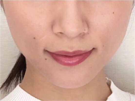 全顔ダブルコース施術後